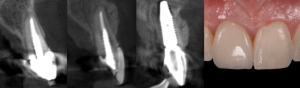 SMART Minimally Invasive Bone Grafting Technique xray images