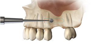SMART Minimally Invasive Bone Grafting Technique before