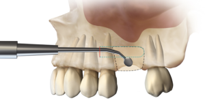 SMART Minimally Invasive Bone Grafting Technique after