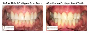 Before and After pictures of Pinhole Surgery - upper front teeth only