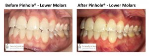 Before and After pictures of Pinhole Surgery - lower molars