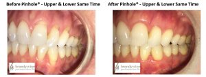 Before and After pictures of Pinhole Surgery - upper and lower gums at the same time