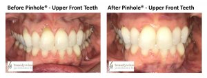 Before and After pictures of Pinhole Surgery - upper front teeth