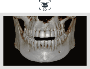 3D Digital scan of a patient's jaw
