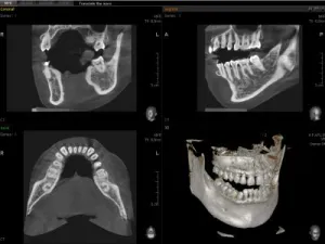 Cone Beam CT Scan 3D Digital Image of a patient's jaw